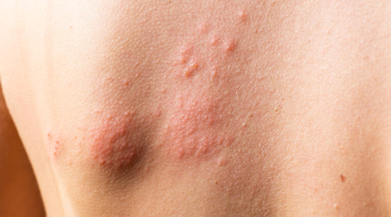 Pásový opar (herpes zoster) – příznaky a jeho léčba